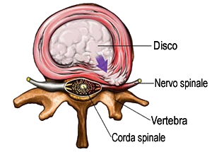 Ernia discale
